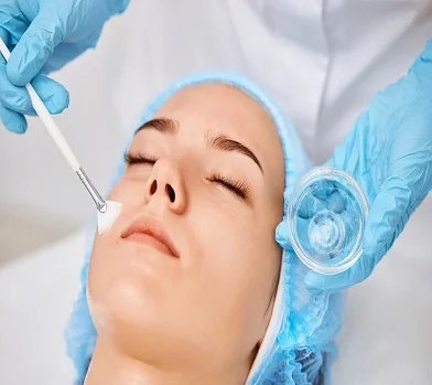 Chemical Peel